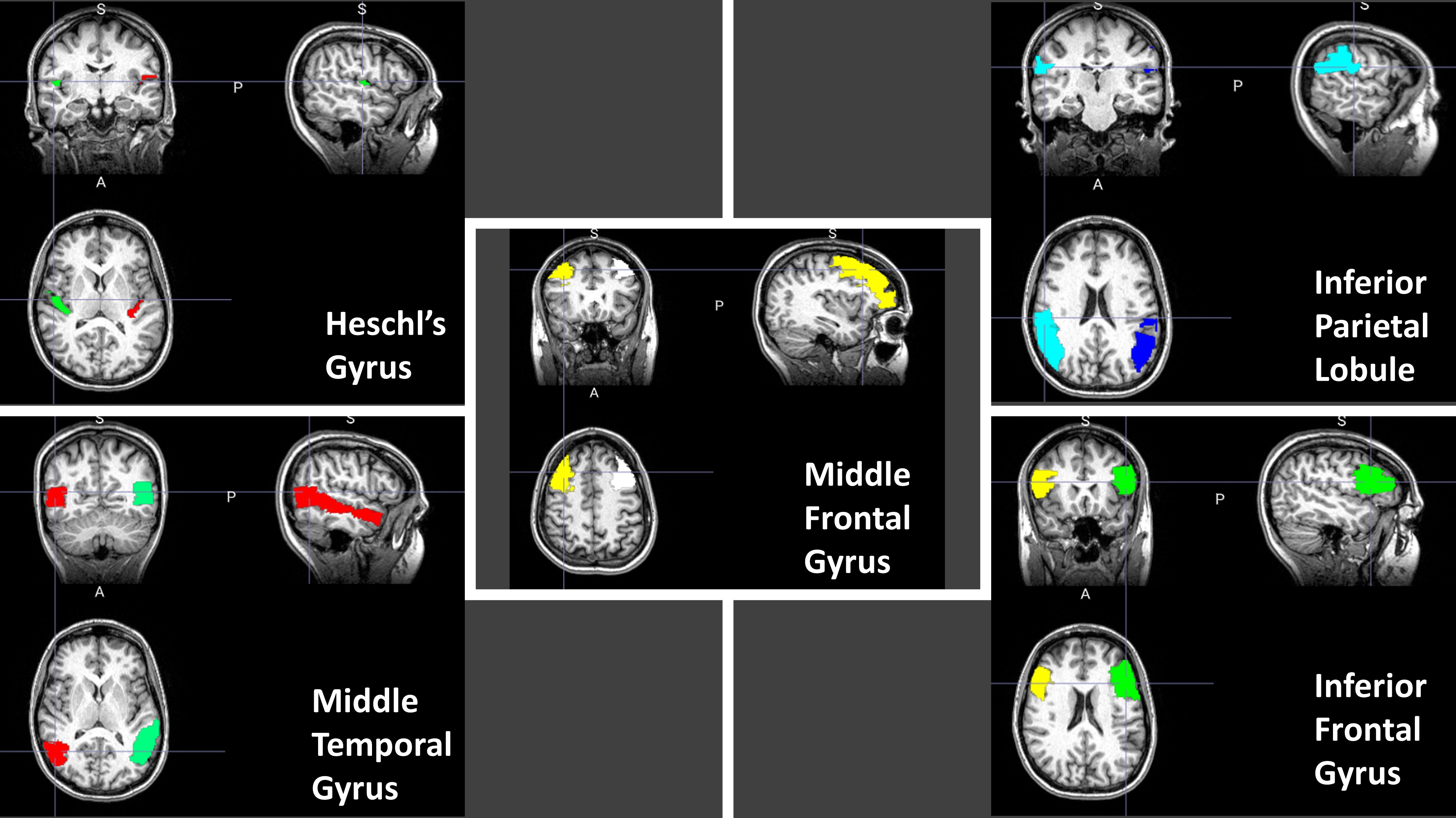 Brain Volume