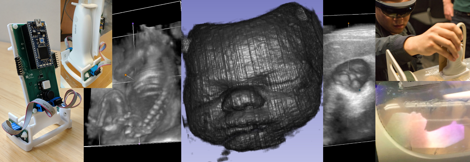 Augmented Ultrasound Acquisition & Visualization